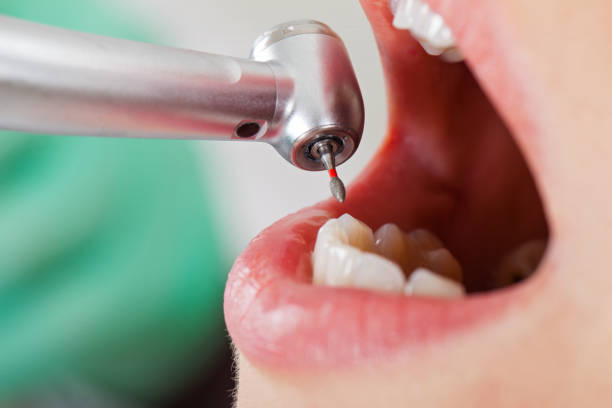 Best Emergency Tooth Extraction in Montrose Ghent, OH